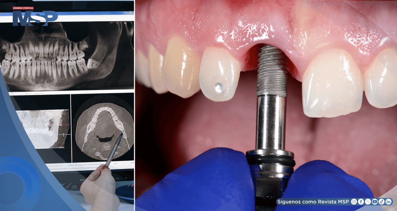 Implantes orales metálicos estarían aumentando el riesgo de enfermedades, según estudios 