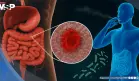 El tabaquismo podría alterar la microbiota intestinal con efectos opuestos en colitis ulcerosa y Crohn