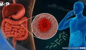 El tabaquismo podría alterar la microbiota intestinal con efectos opuestos en colitis ulcerosa y Crohn