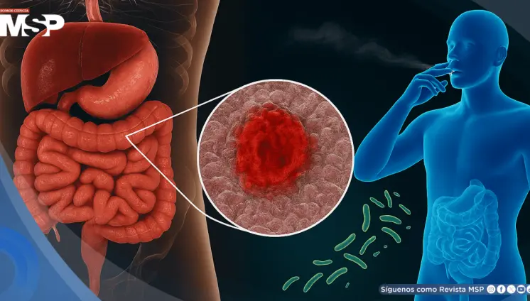 El tabaquismo podría alterar la microbiota intestinal con efectos opuestos en colitis ulcerosa y Crohn