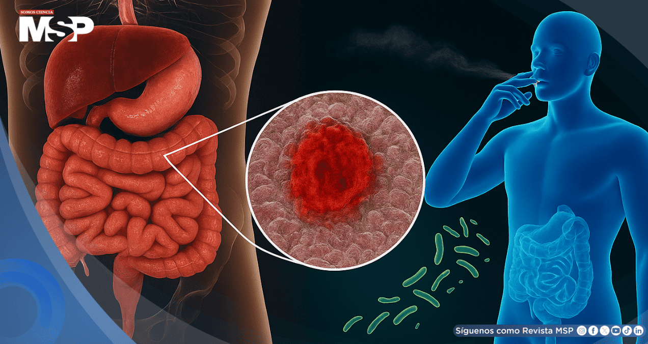 El tabaquismo podría alterar la microbiota intestinal con efectos opuestos en colitis ulcerosa y Crohn