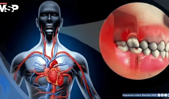 Bacterias bucales podrían migrar a las arterias, causar inflamación y aumentar el riesgo de infarto