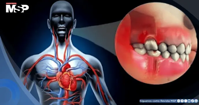Bacterias bucales podrían migrar a las arterias, causar inflamación y aumentar el riesgo de infarto