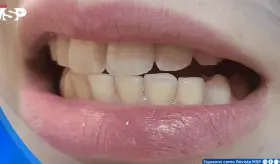 Bruxismo por trastorno de ansiedad ocasiona cefaleas tensionales y dolor cervical en joven de 19 años