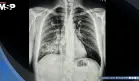 Tuberculosis primaria se manifiesta con tos persistente e infiltrado pulmonar en hombre de 45 años 