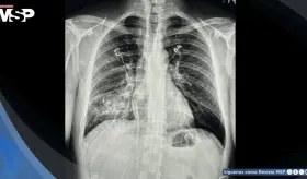 Tuberculosis primaria se manifiesta con tos persistente e infiltrado pulmonar en hombre de 45 años 