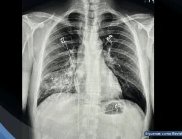 Tuberculosis primaria se manifiesta con tos persistente e infiltrado pulmonar en hombre de 45 años 