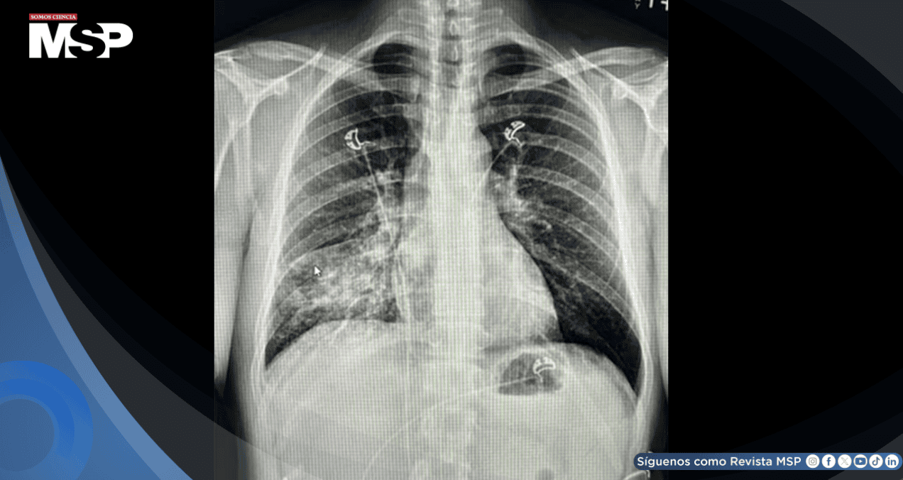 Tuberculosis primaria se manifiesta con tos persistente e infiltrado pulmonar en hombre de 45 años 