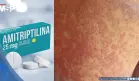 Reacciones cutáneas graves asociado al uso de amitriptilina: Todo lo que debe saber sobre este fármaco