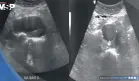 Detectan aneurisma de aorta abdominal de 4.4 cm en hombre con pulsaciones en el abdomen