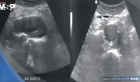 Detectan aneurisma de aorta abdominal de 4.4 cm en hombre con pulsaciones en el abdomen