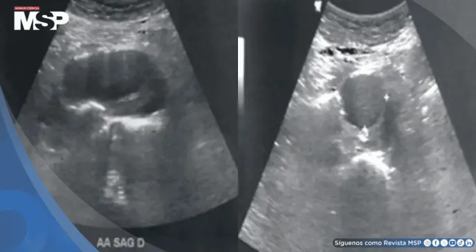 Detectan aneurisma de aorta abdominal de 4.4 cm en hombre con pulsaciones en el abdomen