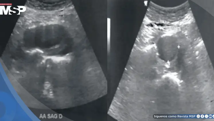 Detectan aneurisma de aorta abdominal de 4.4 cm en hombre con pulsaciones en el abdomen