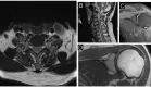 Neuritis braquial diagnosticada en hombre de 50 años tras dolor y pérdida de fuerza en hombro izquierdo