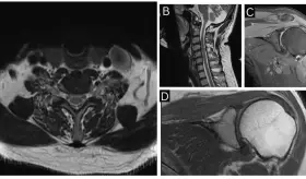 Neuritis braquial diagnosticada en hombre de 50 años tras dolor y pérdida de fuerza en hombro izquierdo