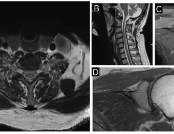 Neuritis braquial diagnosticada en hombre de 50 años tras dolor y pérdida de fuerza en hombro izquierdo