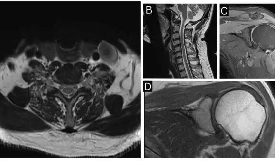 Neuritis braquial diagnosticada en hombre de 50 años tras dolor y pérdida de fuerza en hombro izquierdo
