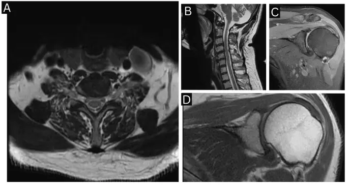 Neuritis braquial diagnosticada en hombre de 50 años tras dolor y pérdida de fuerza en hombro izquierdo