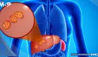 Dolor abdominal, hinchazón e ictericia: Así se manifiestan los quistes hepáticos complicados