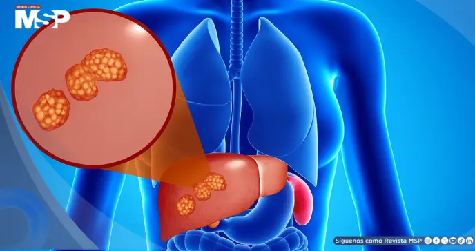 Dolor abdominal, hinchazón e ictericia: Así se manifiestan los quistes hepáticos complicados