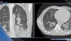 Diagnostican neumonitis química en joven de 19 años por uso diario de cigarrillos electrónicos