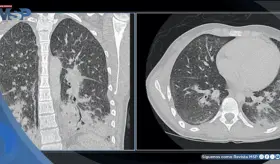 Diagnostican neumonitis química en joven de 19 años por uso diario de cigarrillos electrónicos