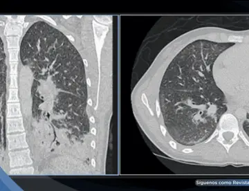 Diagnostican neumonitis química en joven de 19 años por uso diario de cigarrillos electrónicos