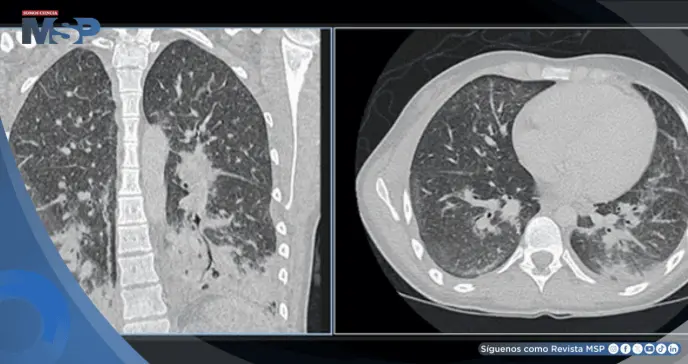 Diagnostican neumonitis química en joven de 19 años por uso diario de cigarrillos electrónicos