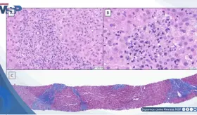 Hepatitis autoinmune inducida por anastrozol con orina oscura e hiporexia en paciente con cáncer de mama