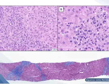 Hepatitis autoinmune inducida por anastrozol con orina oscura e hiporexia en paciente con cáncer de mama