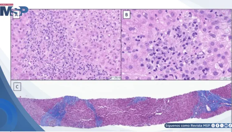 Hepatitis autoinmune inducida por anastrozol con orina oscura e hiporexia en paciente con cáncer de mama