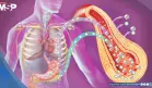 Diabetes tipo 2 altera la estructura del corazón y aumenta el riesgo de insuficiencia cardíaca: Estudio