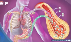 Diabetes tipo 2 altera la estructura del corazón y aumenta el riesgo de insuficiencia cardíaca: Estudio