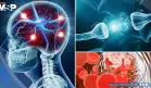 La inflamación crónica afectaría al cerebro con deterioro cognitivo, riesgo de demencia y depresión