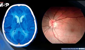 Hipertensión intracraneal asociada al uso de isotretinoína y vitamina A para el acné en mujer con cefalea