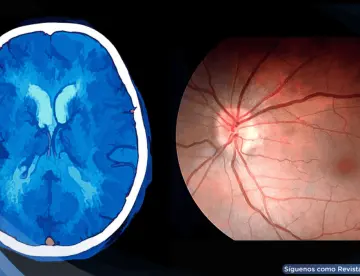 Hipertensión intracraneal asociada al uso de isotretinoína y vitamina A para el acné en mujer con cefalea