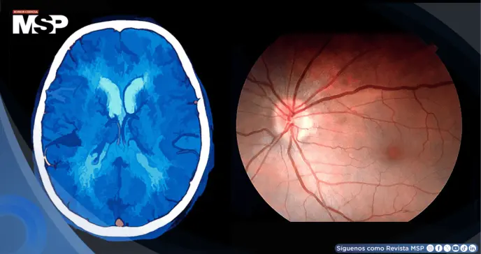 Hipertensión intracraneal asociada al uso de isotretinoína y vitamina A para el acné en mujer con cefalea