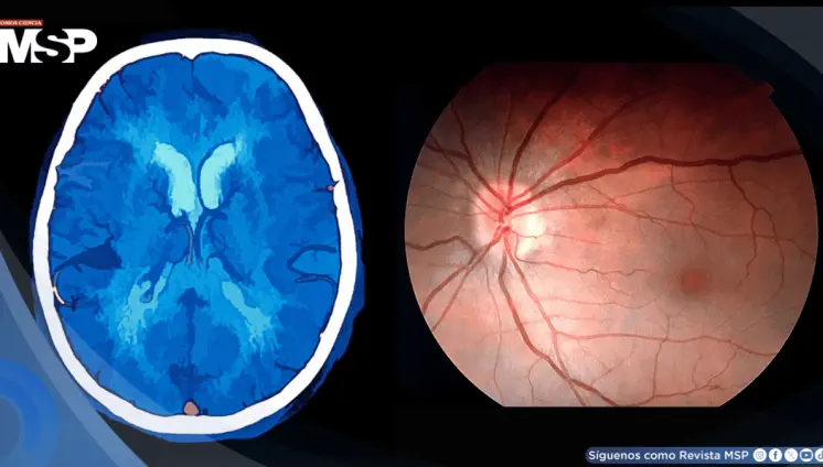 Hipertensión intracraneal asociada al uso de isotretinoína y vitamina A para el acné en mujer con cefalea Hipertensión intracraneal asociada al uso de isotretinoína y vitamina A para el acné en mujer con cefalea