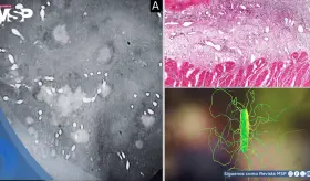 Neumonía bacteriana y colitis por C. difficile en mujer de 55 años tras tos, fiebre y disnea progresiva