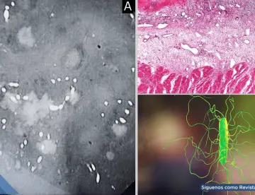 Neumonía bacteriana y colitis por C. difficile en mujer de 55 años tras tos, fiebre y disnea progresiva