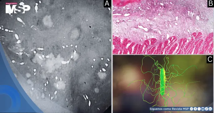 Neumonía bacteriana y colitis por C. difficile en mujer de 55 años tras tos, fiebre y disnea progresiva