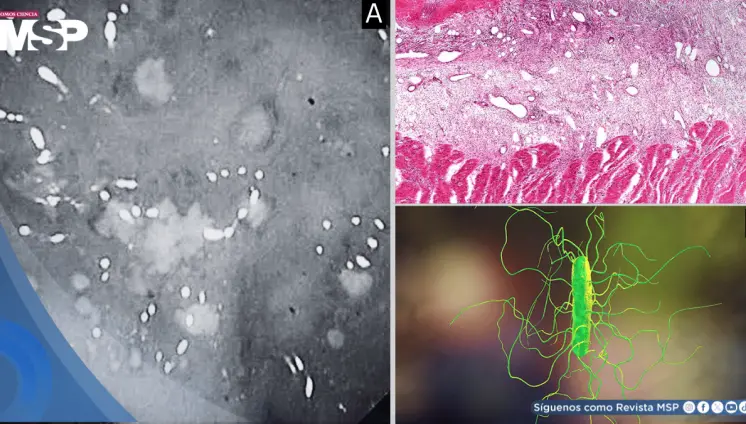Neumonía bacteriana y colitis por C. difficile en mujer de 55 años tras tos, fiebre y disnea progresiva