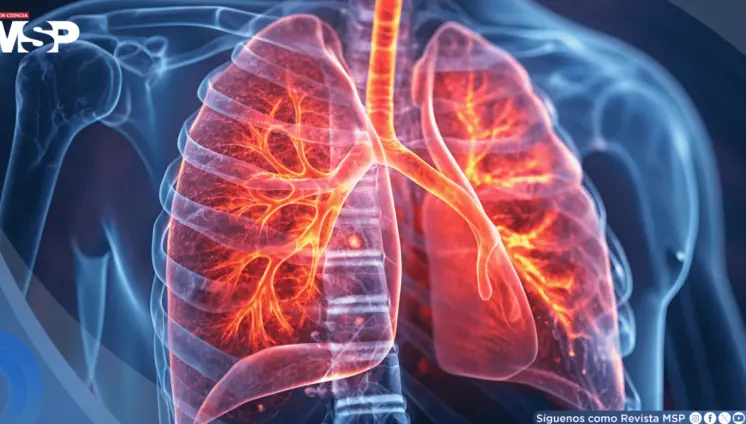 La gripe debilitaría la microbiota pulmonar y abriría la puerta a neumonías e infecciones graves La gripe debilitaría la microbiota pulmonar y abriría la puerta a neumonías e infecciones graves