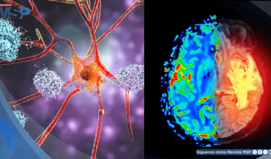 Así combaten el alzhéimer las terapias avanzadas: anticuerpos, placas amiloides y detección temprana