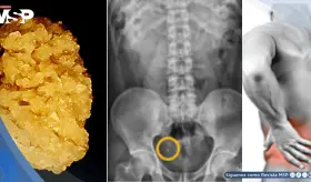 Paciente desarrolla cálculos renales por exceso de carbonato de calcio para acidez y osteoporosis