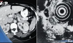 Parálisis periférica, confusión y desmayos revelan raro caso de tumor productor de insulina