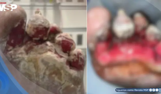 Lesión en el pie evoluciona a infección fúngica por Pseudomonas aeruginosa resistente a antifúngicos