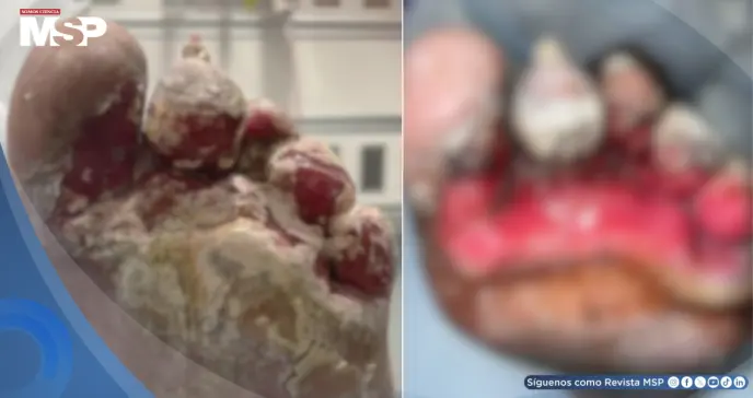 Lesión en el pie evoluciona a infección fúngica por Pseudomonas aeruginosa resistente a antifúngicos