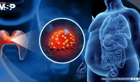 Inflamación crónica por obesidad y diabetes aceleraría el cáncer de tiroides