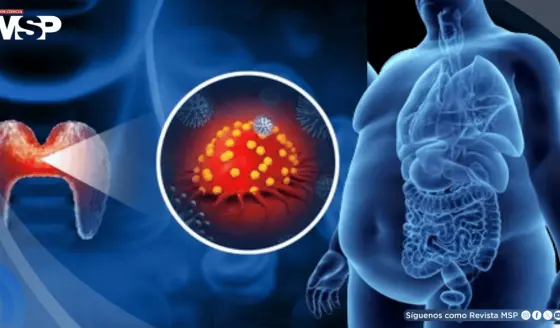 Inflamación crónica por obesidad y diabetes aceleraría el cáncer de tiroides y reduciría eficacia de trat